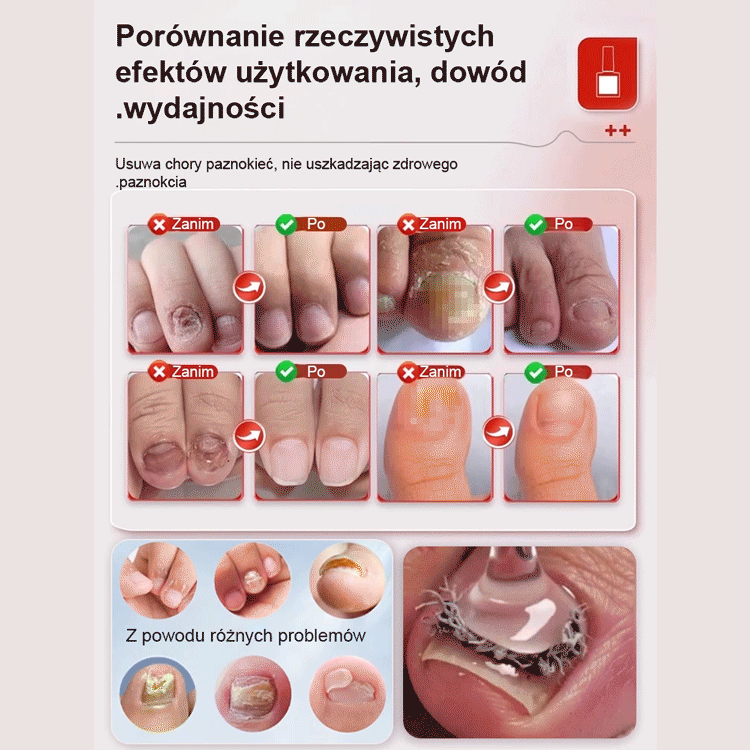 Ziołowe Serum do Regeneracji Paznokci – Skuteczny Preparat na Grzybicę i Odbudowę Płytki (Z Kwasem Hialuronowym)